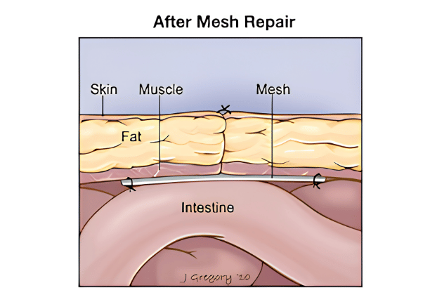 Enterocele mesh repair before and after